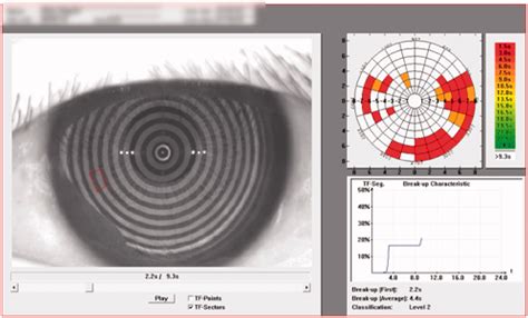 tear free claim test report interpretation|cpt code for tear film.